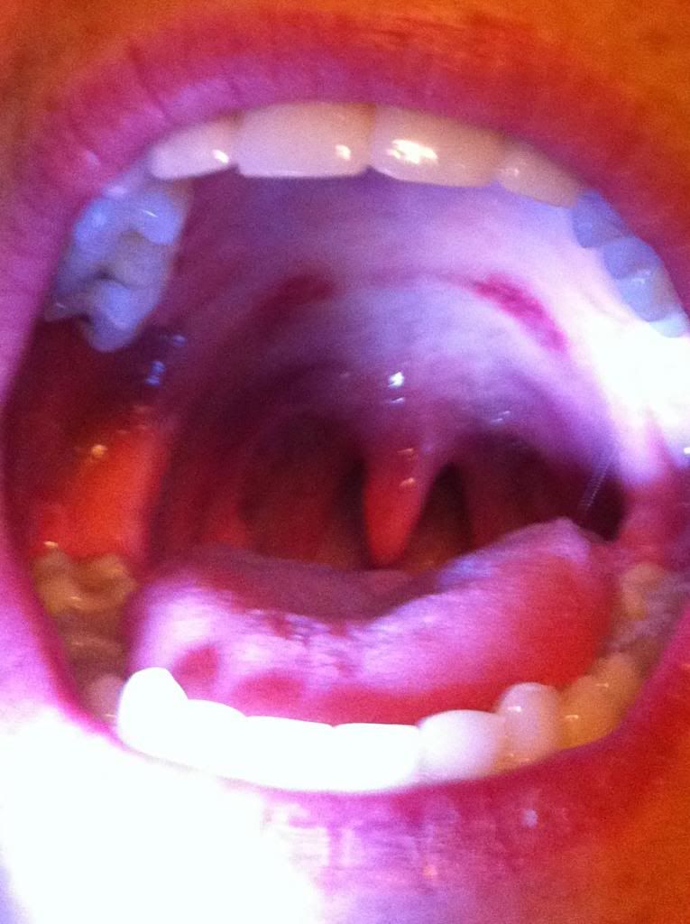 Rough Red Patch On Roof Of Mouth