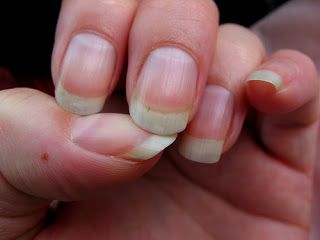 how to cure nail fungus